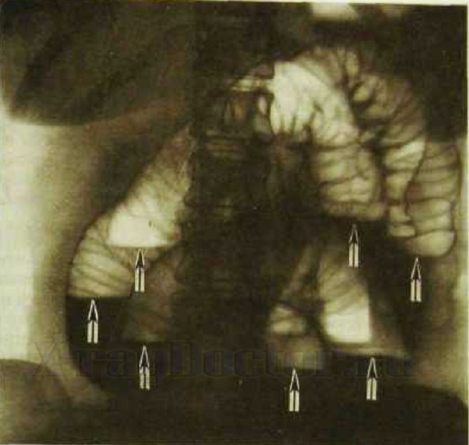 рентген брюшной полости при острой кишечной непроходимости